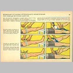 056 Временная остановка артериального кровотечения при помощи жгута или закрутки